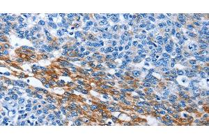 Immunohistochemistry of paraffin-embedded Human ovarian cancer tissue using PAK6 Polyclonal Antibody at dilution 1:40 (PAK6 anticorps)