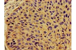 Immunohistochemistry of paraffin-embedded human cervical cancer using ABIN7149290 at dilution of 1:100 (CD131 anticorps  (AA 492-710))