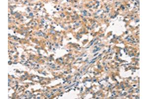 The image on the left is immunohistochemistry of paraffin-embedded Human thyroid cancer tissue using ABIN7193053(WNK3 Antibody) at dilution 1/20, on the right is treated with synthetic peptide. (WNK3 anticorps)