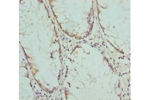 Immunohistochemistry of paraffin-embedded human colon cancer using ABIN7148459 at dilution of 1:100 (COG5 anticorps  (AA 1-260))