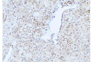 ABIN6275233 at 1/100 staining Human lung cancer tissue by IHC-P. (MRPS21 anticorps  (C-Term))