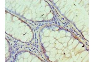 Immunohistochemistry of paraffin-embedded human colon cancer using ABIN7157125 at dilution of 1:100