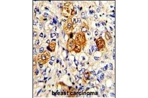Formalin-fixed and paraffin-embedded human breast carcinoma with C5 Antibody (N-term), which was peroxidase-conjugated to the secondary antibody, followed by DAB staining. (C5 anticorps  (N-Term))