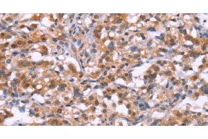 Immunohistochemistry of paraffin-embedded Human thyroid cancer tissue using BRK1 Polyclonal Antibody at dilution 1:30