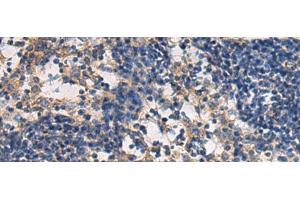 Immunohistochemistry of paraffin-embedded Human esophagus cancer tissue using DMRTA2 Polyclonal Antibody at dilution of 1:50(x200) (DMRTA2 anticorps)