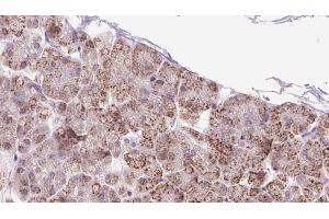 ABIN6273246 at 1/100 staining Human pancreas cancer tissue by IHC-P.