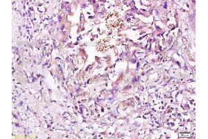 Formalin-fixed and paraffin embedded human esophageal carcinoma labeled with Rabbit Anti CD56/NCAM1 Polyclonal Antibody, Unconjugated (ABIN728398) at 1:200 followed by conjugation to the secondary antibody and DAB staining (CD56 anticorps  (AA 621-720))