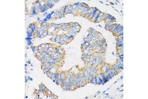 Immunohistochemistry of paraffin-embedded Human colon carcinoma using RPL35 Rabbit pAb (ABIN7270004) at dilution of 1:100 (40x lens). (RPL35 anticorps  (AA 50-120))