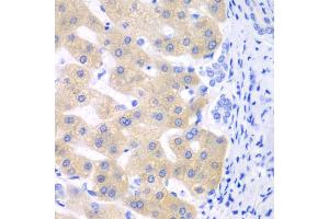 Immunohistochemistry of paraffin-embedded human liver cancer using CYP2C18 antibody (ABIN5975711) at dilution of 1/100 (40x lens). (CYP2C18 anticorps)