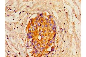 Immunohistochemistry of paraffin-embedded human breast cancer using ABIN7156293 at dilution of 1:100