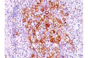 Formalin-fixed, paraffin-embedded human Hodgkin's lymphoma stained with CD30 Ab (CD30/412).