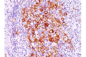 Formalin-fixed, paraffin-embedded human Hodgkin's lymphoma stained with CD30 Ab (CD30/412). (TNFRSF8 anticorps)