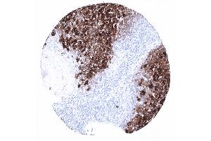 Follicular thyroid cancer with strong thyroglobulin expression