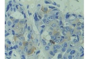 Detection of CAPS in Human Breast cancer Tissue using Polyclonal Antibody to Calcyphosine (CAPS)