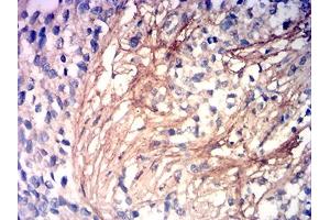 Immunohistochemical analysis of paraffin-embedded cervical cancer tissues using COL3A1 mouse mAb with DAB staining.