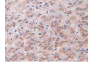 IHC-P analysis of Human Liver Cancer Tissue, with DAB staining. (AKAP11 anticorps  (AA 1650-1901))