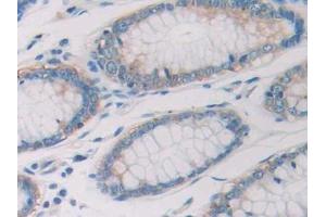 DAB staining on IHC-P; Samples: Human Colorectal cancer Tissue (Ribonuclease A10 (AA 27-216) anticorps)