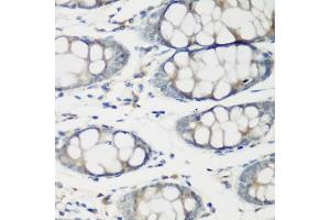 Immunohistochemistry of paraffin-embedded human colon using TNNC2 antibody (ABIN6129604, ABIN6149353, ABIN6149354 and ABIN6223680) at dilution of 1:200 (40x lens). (TNNC2 anticorps  (AA 1-160))