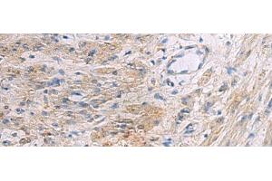 Immunohistochemistry of paraffin-embedded Human gastric cancer tissue using SLC30A3 Polyclonal Antibody at dilution of 1:55(x200) (Slc30a3 anticorps)