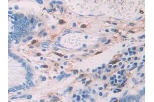 Detection of ADH1 in Human Stomach cancer Tissue using Polyclonal Antibody to Alcohol Dehydrogenase 1 (ADH1)