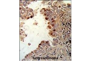 Formalin-fixed and paraffin-embedded human lung carcinoma reacted with PRKCA Antibody (N-term), which was peroxidase-conjugated to the secondary antibody, followed by DAB staining.