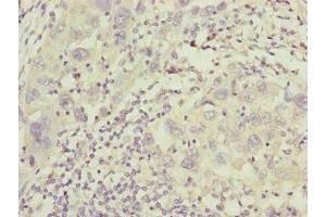 Immunohistochemistry of paraffin-embedded human liver cancer using ABIN7156977 at dilution of 1:100 (IFT20 anticorps  (AA 1-132))