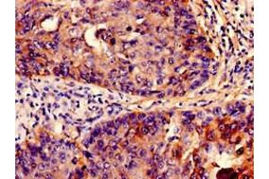Immunohistochemistry analysis of human cervical cancer using ABIN7156687 at dilution of 1:100 (IFITM3 anticorps  (AA 1-57))