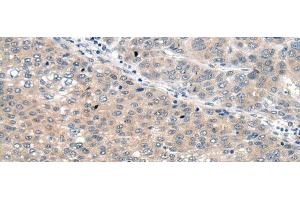 Immunohistochemistry of paraffin-embedded Human liver cancer tissue using SEMA4D Polyclonal Antibody at dilution of 1:60(x200) (SEMA4D/CD100 anticorps)