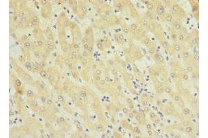 Immunohistochemistry of paraffin-embedded human liver cancer using ABIN7173293 at dilution of 1:100 (TMEM91 anticorps  (AA 1-97))
