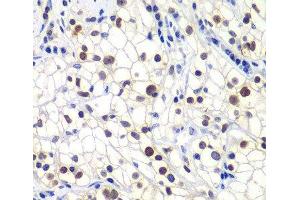 Immunohistochemistry of paraffin-embedded Human kidney cancer using GTF2F2 Polyclonal Antibody at dilution of 1:200 (40x lens). (GTF2F2 anticorps)