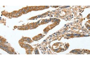 Immunohistochemistry of paraffin-embedded Human colon cancer tissue using CKAP2 Polyclonal Antibody at dilution 1:70 (CKAP2 anticorps)