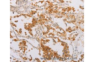 Immunohistochemistry of Human lung cancer using STK40 Polyclonal Antibody at dilution of 1:40 (STK40 anticorps)