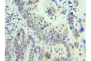 Immunohistochemistry of paraffin-embedded human colon cancer using ABIN7172050 at dilution of 1:100 (THOC1 anticorps  (AA 428-657))