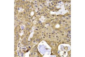 Immunohistochemistry of paraffin-embedded human oophoroma using NAA20 antibody (ABIN5974272) at dilution of 1/100 (40x lens). (NAT5 anticorps)