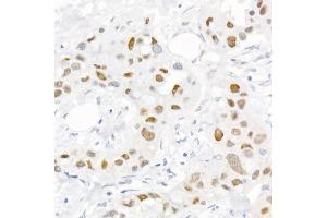 Immunohistochemistry of paraffin-embedded human breast cancer using Phospho-c-Jun-S73 Rabbit pAb (ABIN3023567, ABIN3023568, ABIN3023569 and ABIN6225411) at dilution of 1:25 (40x lens). (C-JUN anticorps  (pSer73))