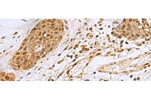 Immunohistochemistry of paraffin-embedded Human esophagus cancer tissue using NVL Polyclonal Antibody at dilution of 1:80(x200) (NVL anticorps)