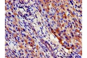 Immunohistochemistry of paraffin-embedded human liver cancer using ABIN7169599 at dilution of 1:100 (SIGMAR1 anticorps  (AA 112-169))
