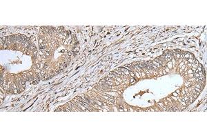 Immunohistochemistry of paraffin-embedded Human colorectal cancer tissue using UQCRQ Polyclonal Antibody at dilution of 1:45(x200)