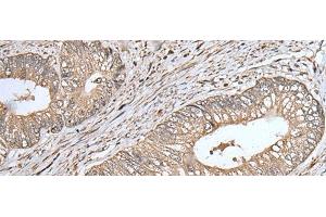 Immunohistochemistry of paraffin-embedded Human colorectal cancer tissue using UQCRQ Polyclonal Antibody at dilution of 1:45(x200) (UQCRQ anticorps)