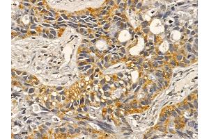 Integrin alpha 3 Mouse Monoclonal Antibody at 1/100 staining human lung cancer and adjacent non-tumor tissue by IHC-P. (ITGA3 anticorps  (Internal Region))