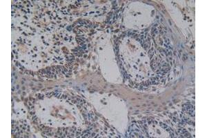 IHC-P analysis of Human Skin Cancer Tissue, with DAB staining. (NFkB anticorps  (AA 805-892))