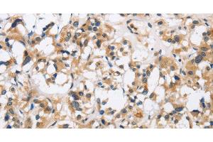Immunohistochemistry of paraffin-embedded Human thyroid cancer using CKMT2 Polyclonal Antibody at dilution of 1:60 (CKMT2 anticorps)