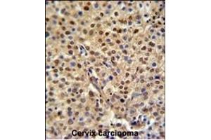 C19orf21 Antibody (N-term) (ABIN651044 and ABIN2840046) IHC analysis in formalin fixed and paraffin embedded human cervix carcinoma followed by peroxidase conjugation of the secondary antibody and DAB staining. (C19orf21 anticorps  (N-Term))