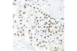 Immunohistochemistry of paraffin-embedded human lung cancer using TRMT1 antibody (ABIN5975089) at dilution of 1/100 (40x lens). (TRMT1 anticorps)