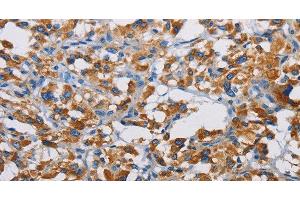 Immunohistochemistry of paraffin-embedded Human thyroid cancer tissue using TSPEAR Polyclonal Antibody at dilution 1:50 (TSPEAR anticorps)