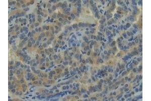 Detection of NRP1 in Human Thyroid cancer Tissue using Polyclonal Antibody to Neuropilin 1 (NRP1) (Neuropilin 1 anticorps  (AA 646-814))