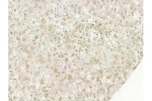 ABIN6264887 and ABIN6276947 at 1/100 staining human astrocytoma by IHC-P. (RUVBL2 anticorps  (Internal Region))