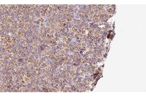 ABIN6273195 at 1/100 staining Human lymph cancer tissue by IHC-P. (SLC10A2 anticorps  (C-Term))