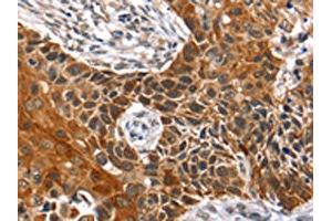 The image on the left is immunohistochemistry of paraffin-embedded Human esophagus cancer tissue using ABIN7129727(HOXB1 Antibody) at dilution 1/40, on the right is treated with fusion protein.