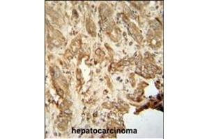 NAT14 antibody (N-term) (ABIN654245 and ABIN2844071) immunohistochemistry analysis in formalin fixed and paraffin embedded human hepatocarcinoma followed by peroxidase conjugation of the secondary antibody and DAB staining. (NAT14 anticorps  (N-Term))
